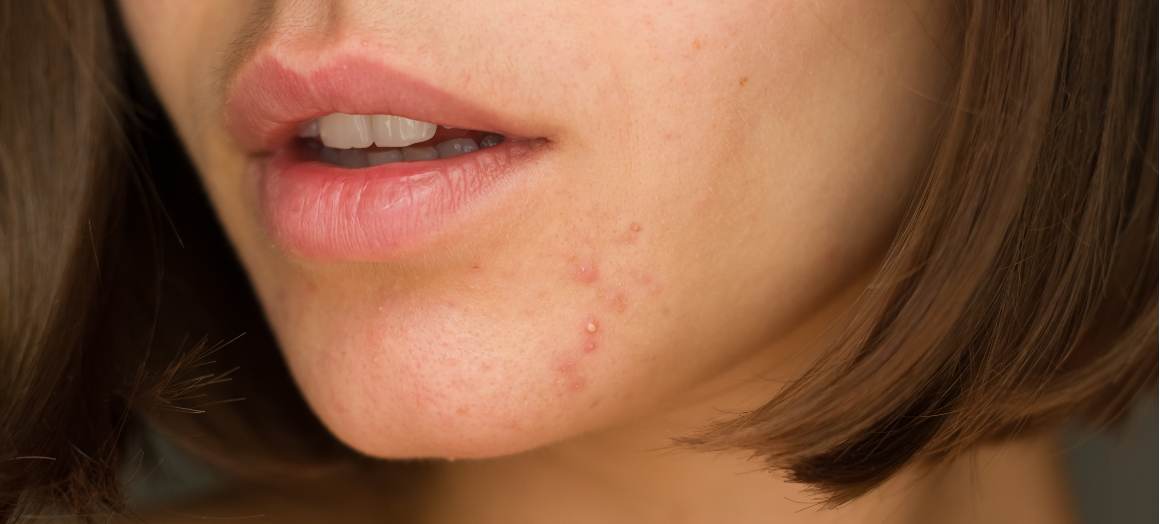 Cosa causa l'acne sul mento?