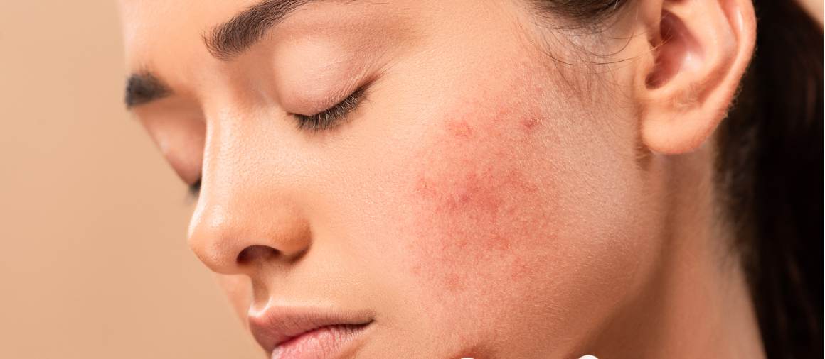 Quale tipo di acne è più difficile da trattare?